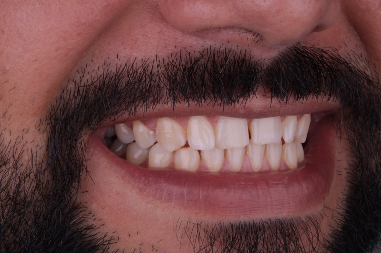 Antes